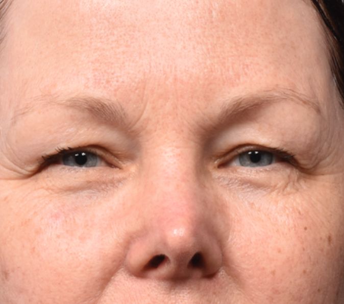 Before image