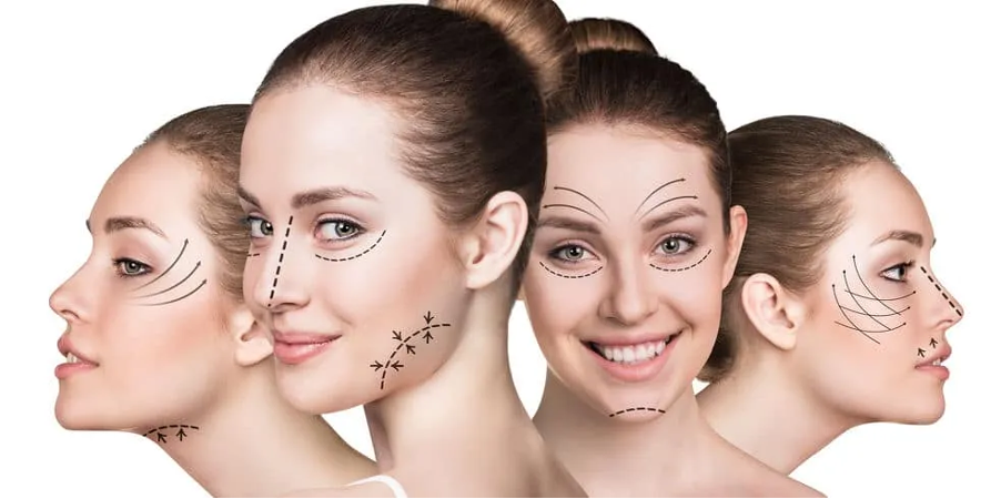 Nâng cơ mặt không phẫu thuật