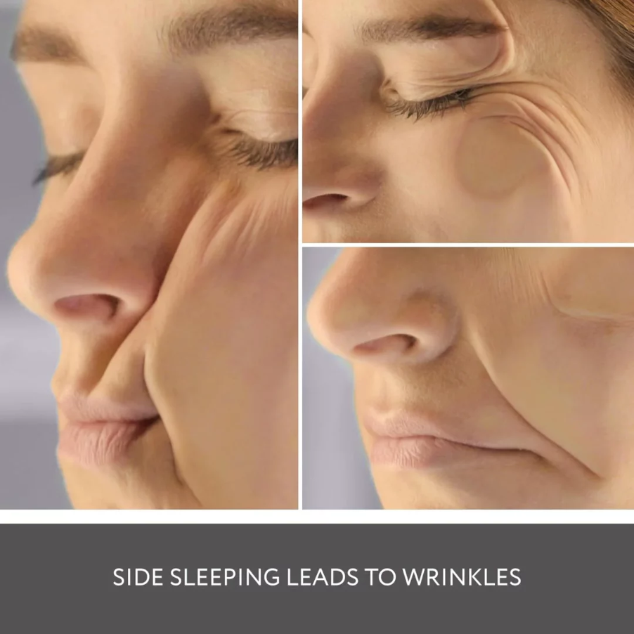 Nếp nhăn do đè nén (Compression Wrinkles)