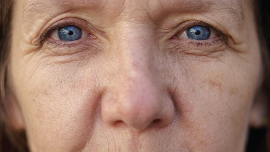 Nếp nhăn teo da (Atrophic Wrinkles)