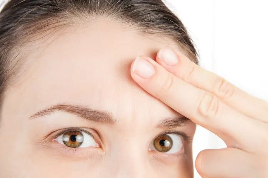 Nếp nhăn do mất đàn hồi (Elastotic Wrinkles)
