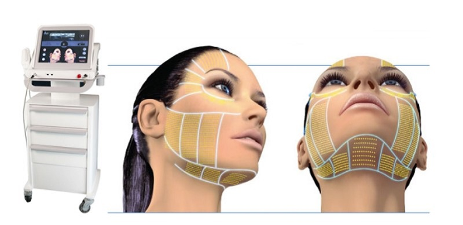 Công nghệ HIFU là gì?