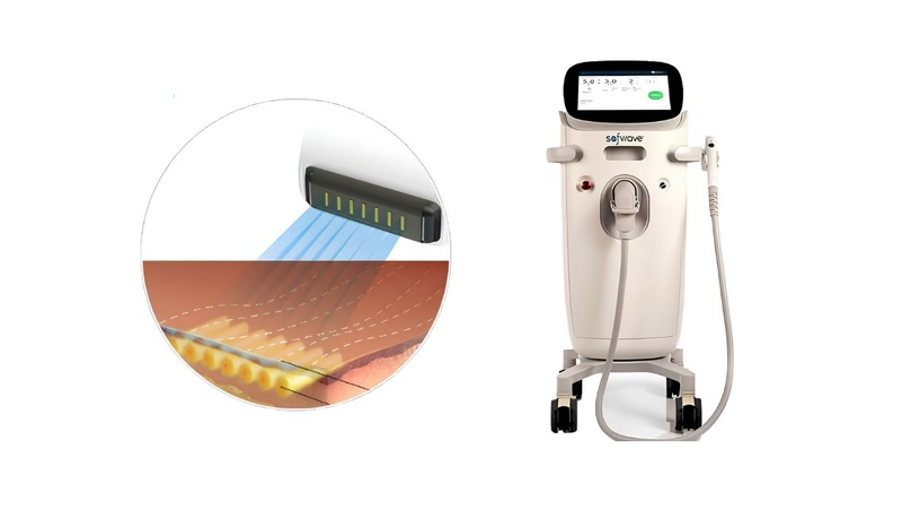 Nên chọn Sofwave™