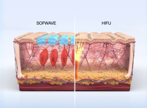 Sofwave™ và HIFU