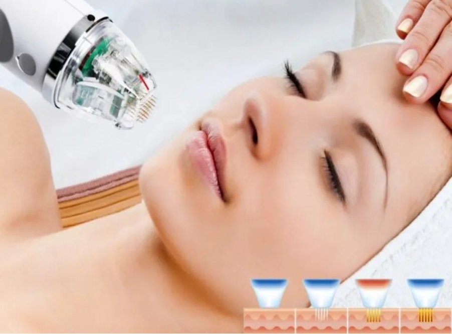 Nhóm Vi kim RF (RF Microneedling)