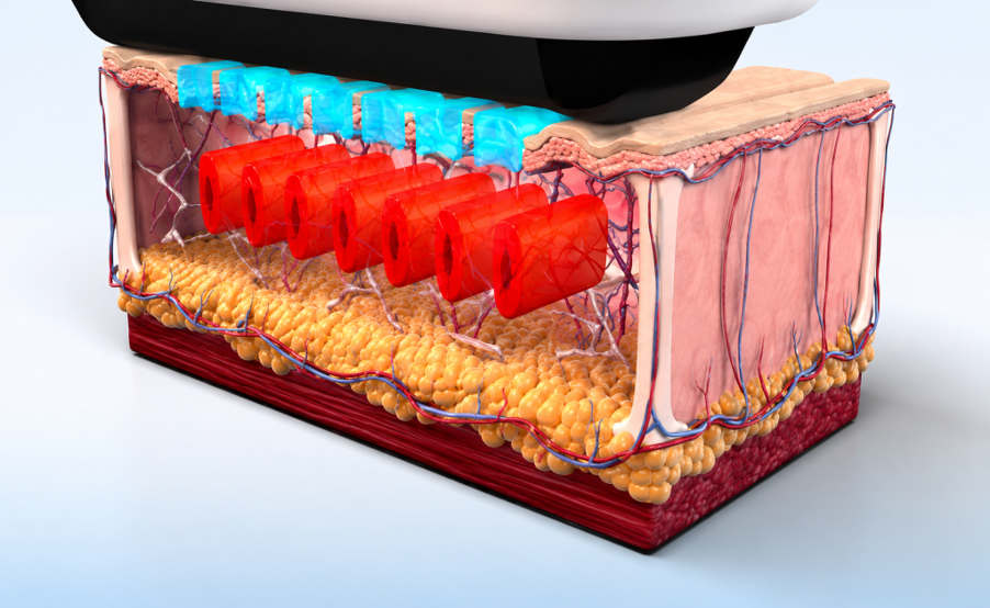 sofwave™ tác động vào làn da bằng cơ chế nào?