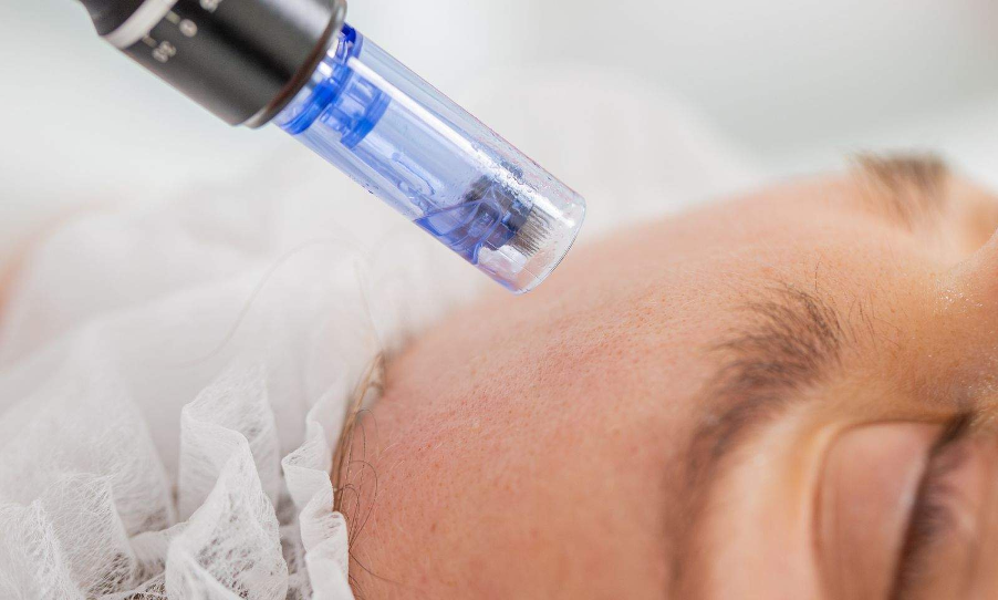 Công nghệ Microneedling