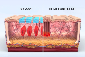 Sofwave vs Microneedling: Điểm giống và khác nhau