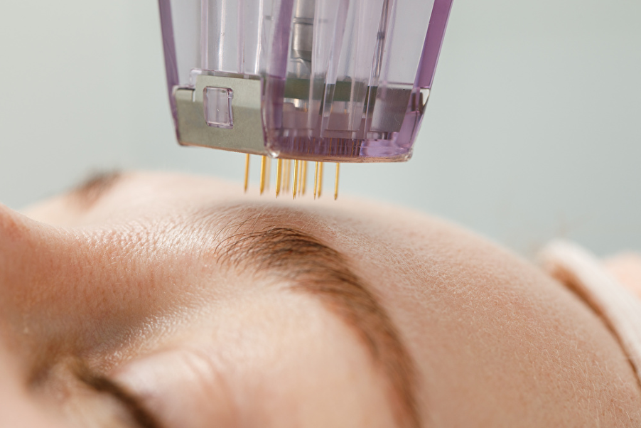 Nên cân nhắc Microneedling